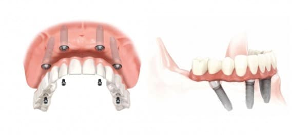 Implantologia osteointegrata