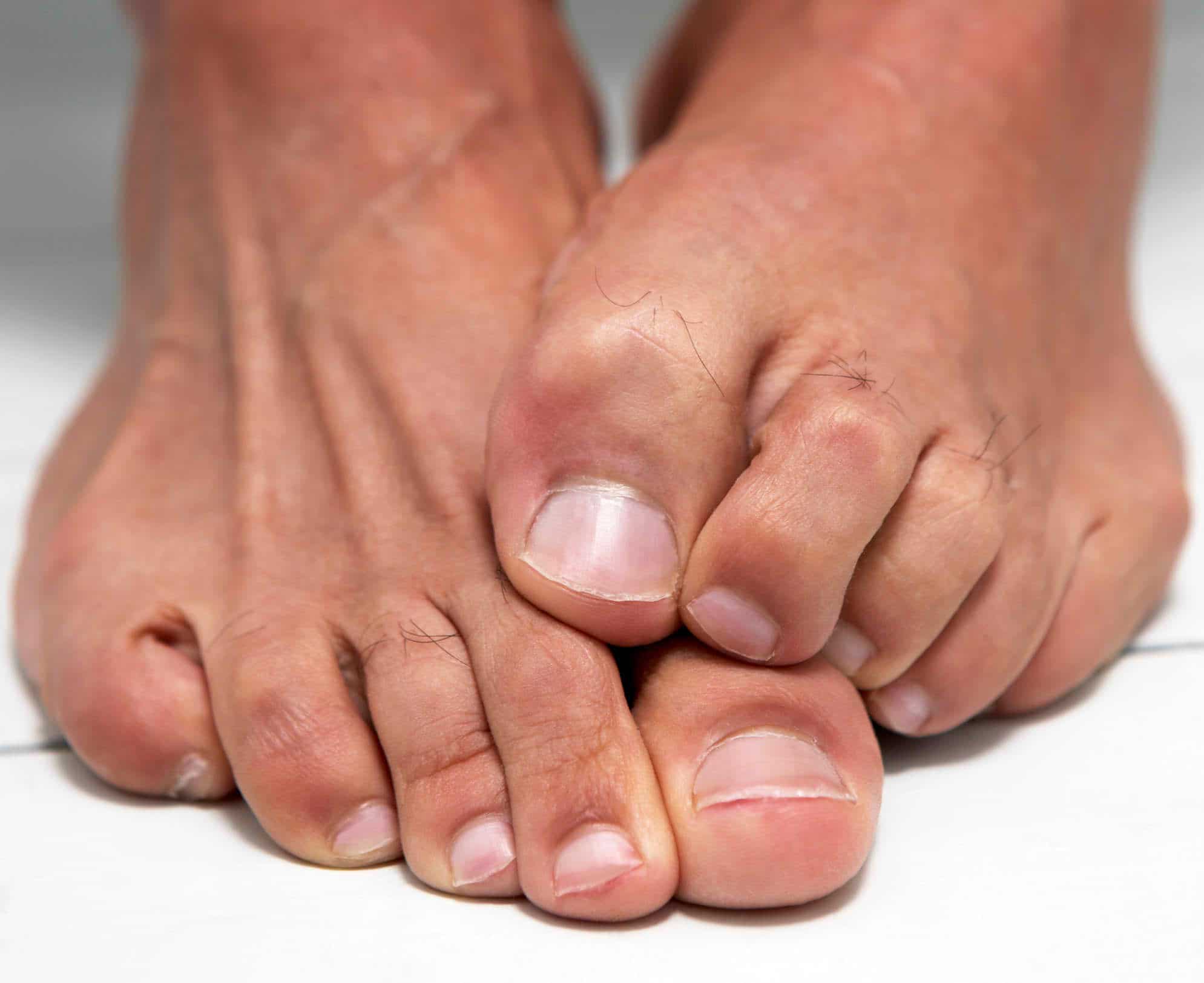 Foot Fungus - Risks, Symptoms and Leading Causes | Treato