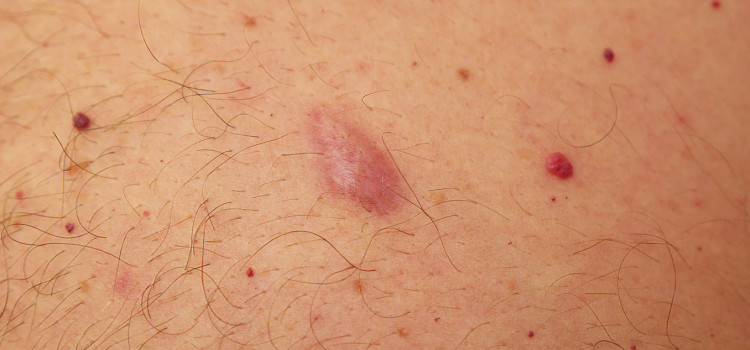 Small Lumps On Dogs Body Small Lumps On Dogs Body