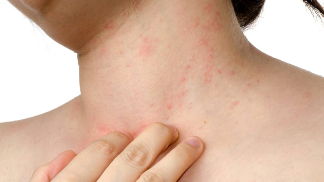 Fungo sulla pelle Vivo di Benessere