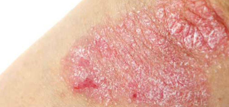 La psoriasi di piatti di unghia che trattare