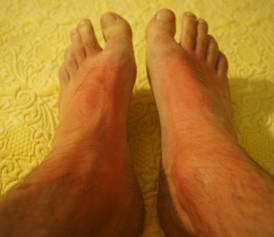 scottatura sole piedi
