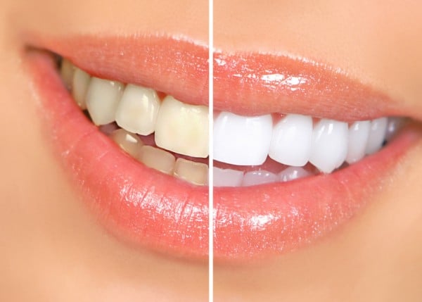 sbiancamento dentatura sbiancamento denti