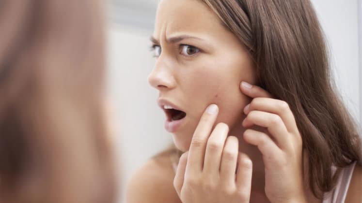 Perchè Non Si Devono Schiacciare I Brufoli