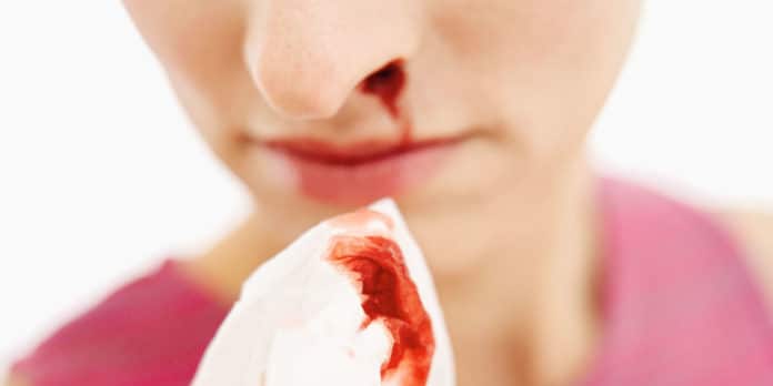 sangue naso sangue naso