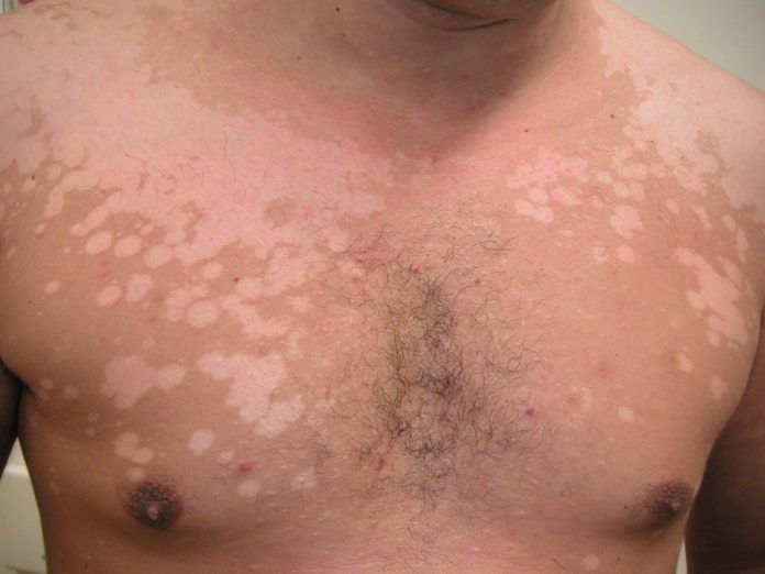Vitiligine guarire è possibile con il pepe nero Vivo di Benessere