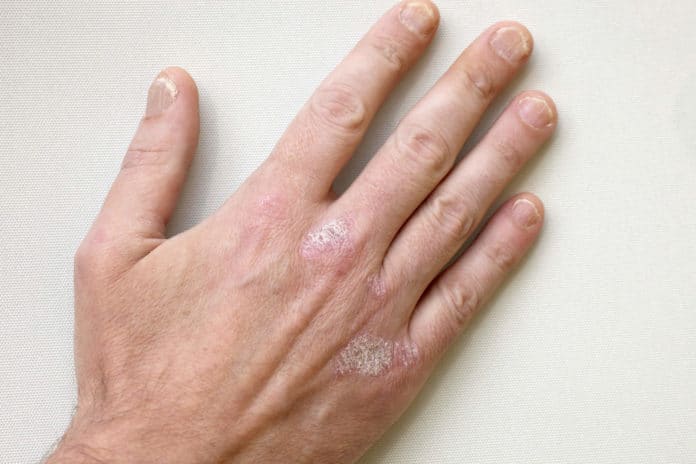 psoriasi psoriasi