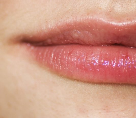 herpes labiale