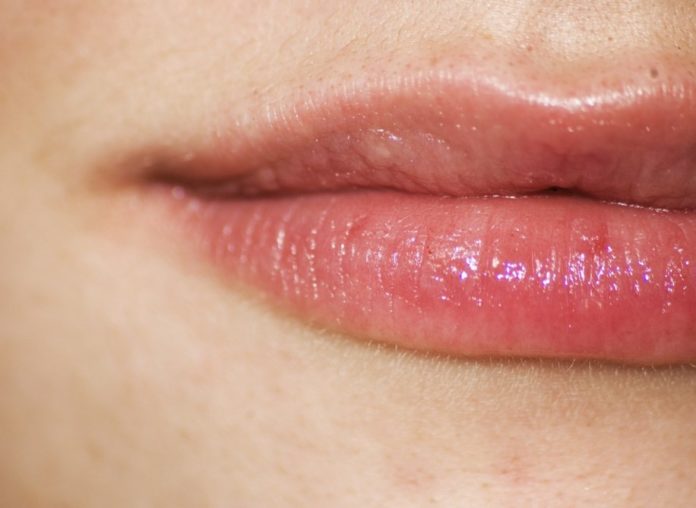 herpes labiale