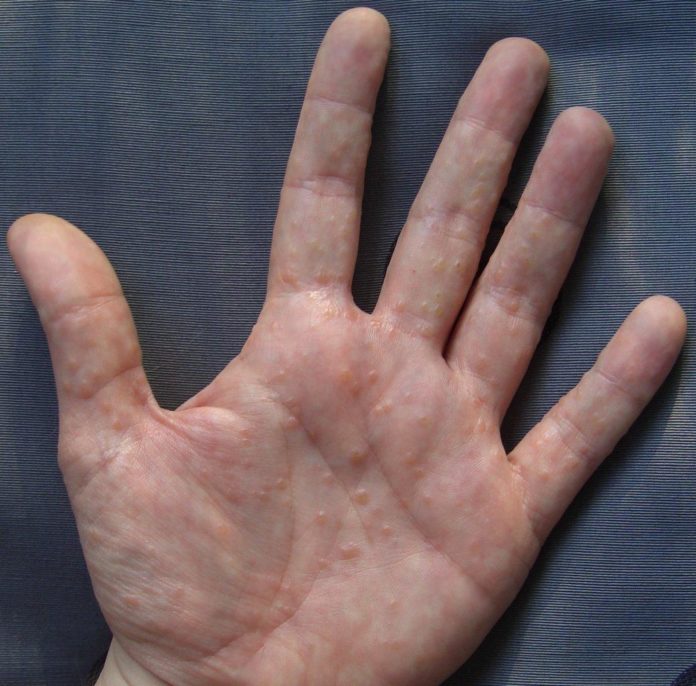 disidrosi disidrosi
