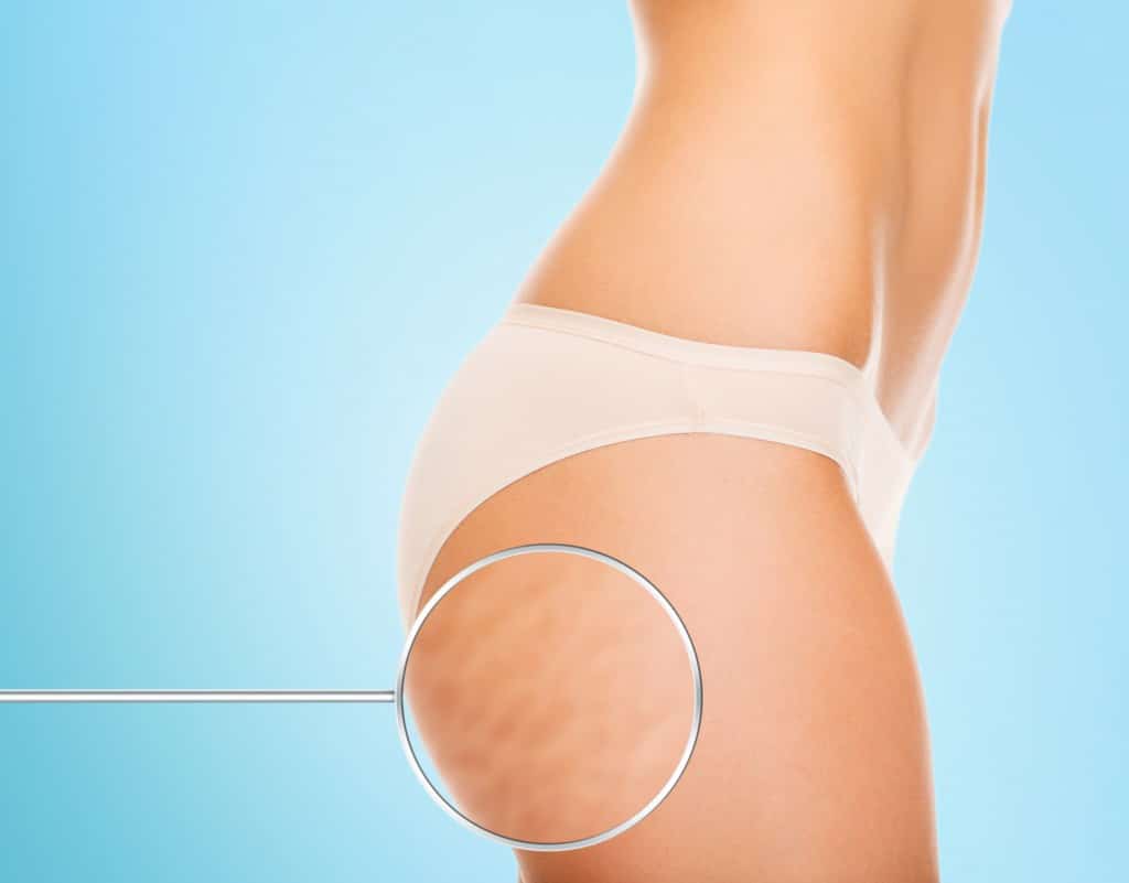 culotte cellulite