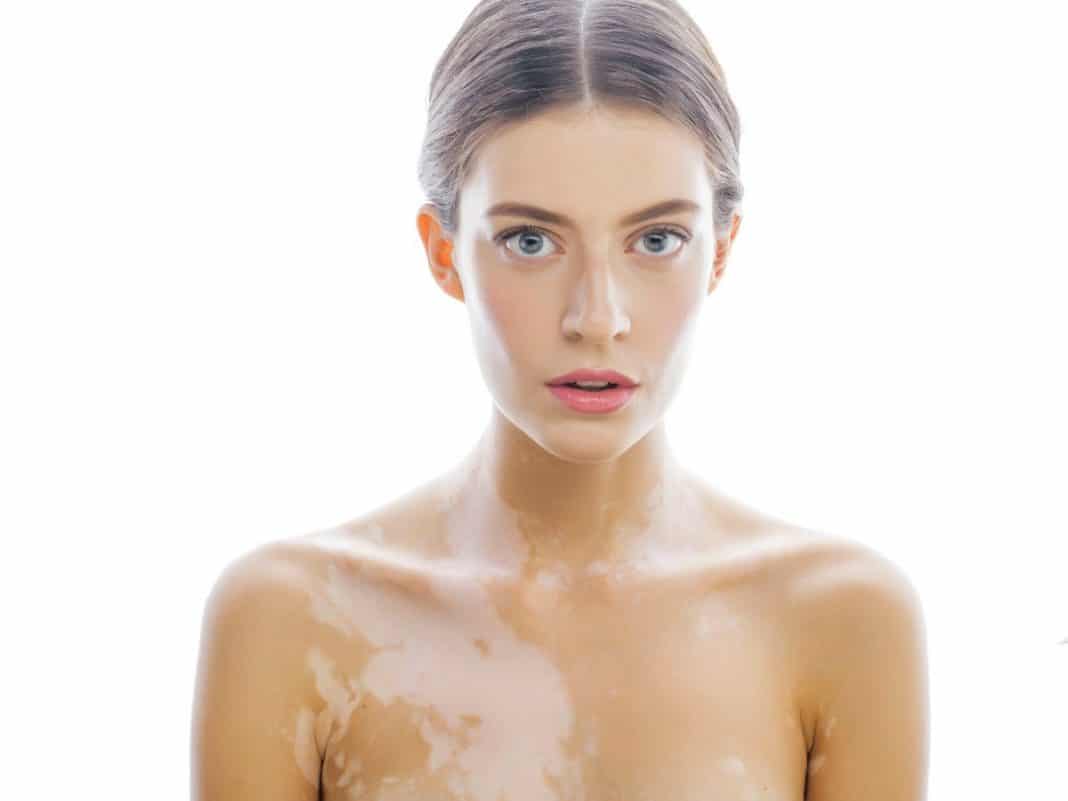 vitiligine-scoperta-proteina-cura