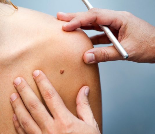 melanoma