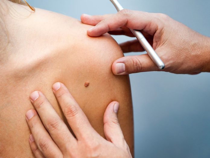 melanoma