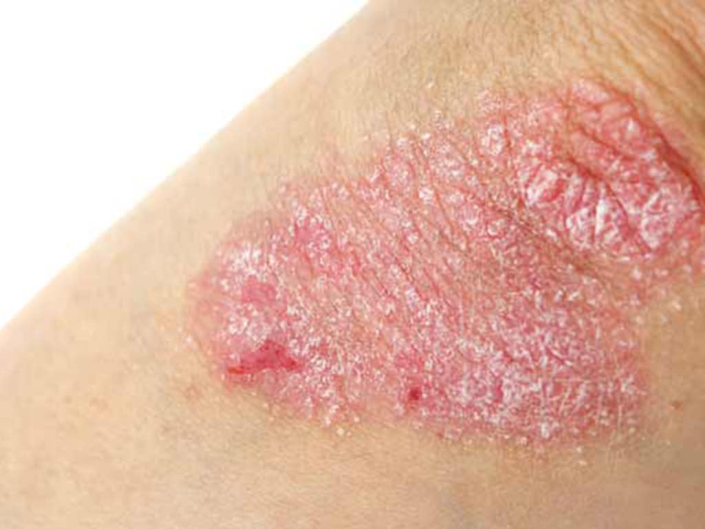 psoriasi dermatite