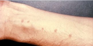 orticaria