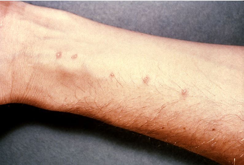 orticaria