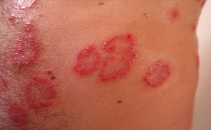 psoriasi rimedi naturali psoriasi rimedi naturali