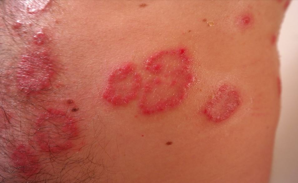 psoriasi rimedi naturali