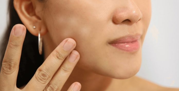 Pelle Viso Irritata Rimedi Naturali