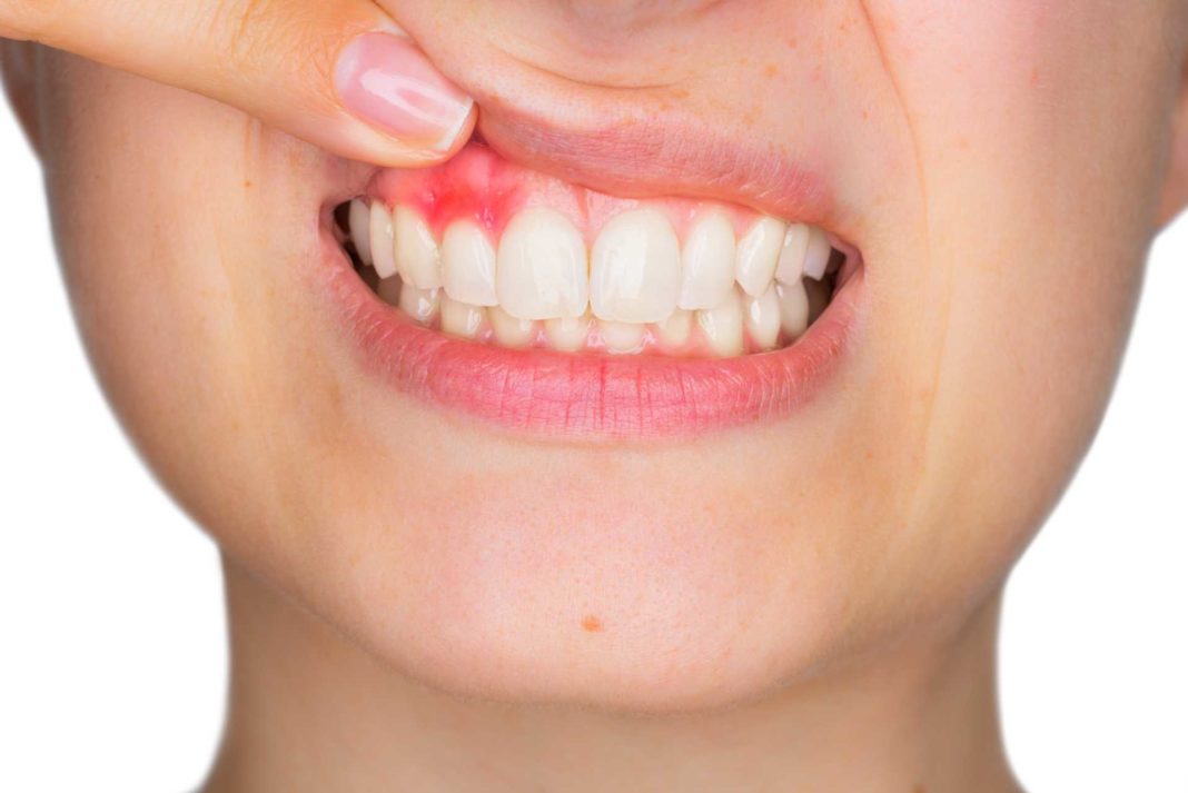 rimedi naturali per ascesso dentale