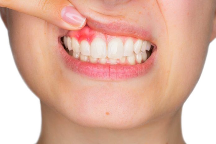 rimedi naturali per ascesso dentale rimedi naturali per ascesso dentale