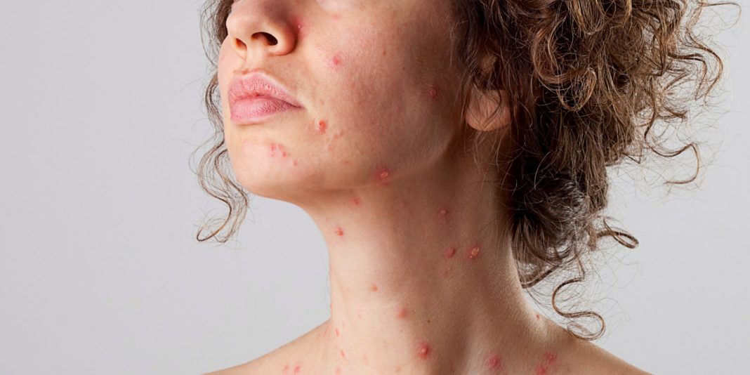 rimedi naturali per impetigine