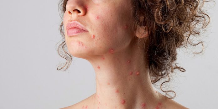 rimedi naturali per impetigine rimedi naturali per impetigine