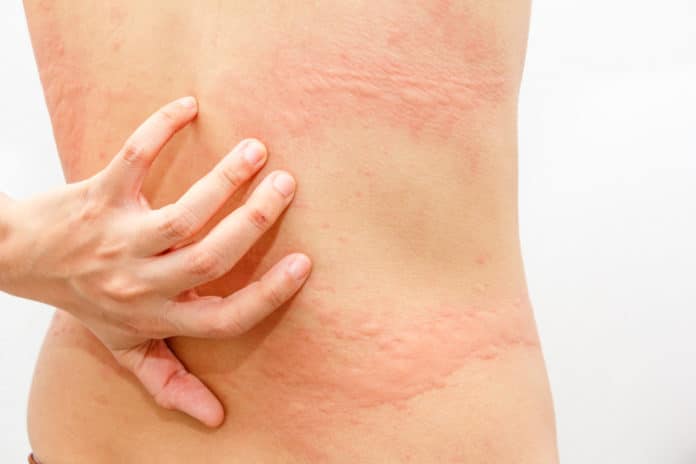 rimedi naturali orticaria stress