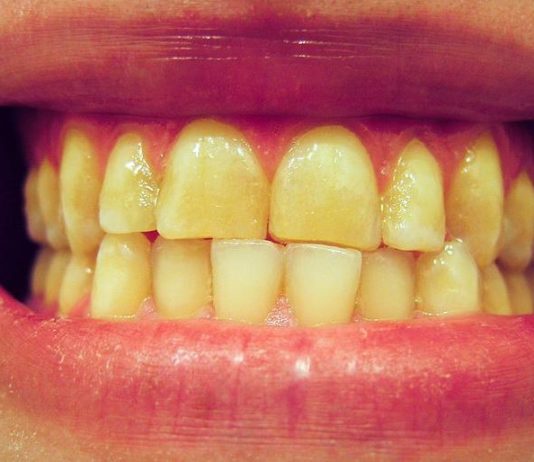 denti gialli