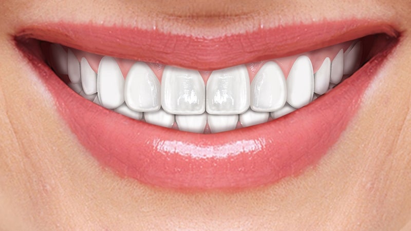 implantologia dentale