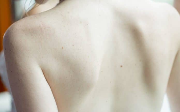 acne schiena acne schiena