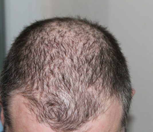 trapianto capelli