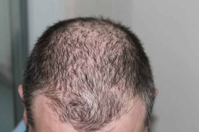 trapianto capelli trapianto capelli