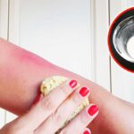 Il rimedio semplice e naturale per alleviare le scottature solari!