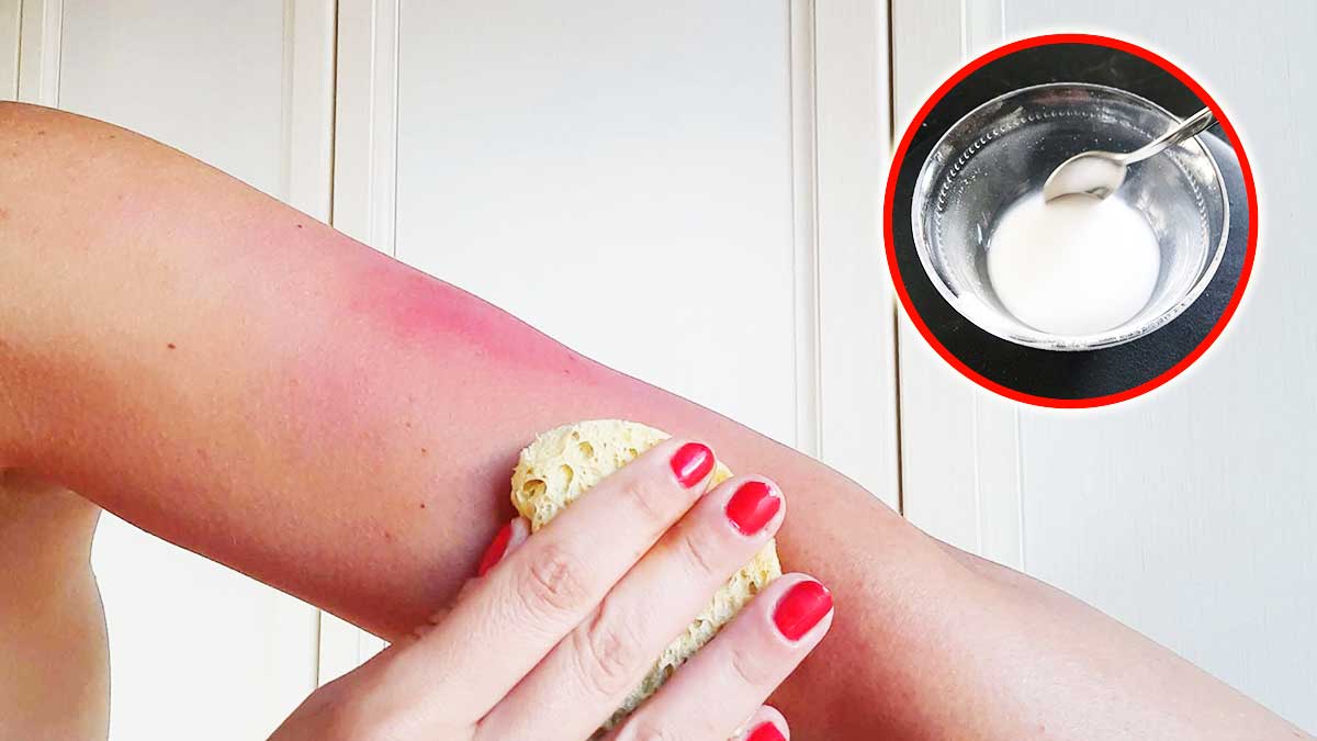 Il rimedio semplice e naturale per alleviare le scottature solari!