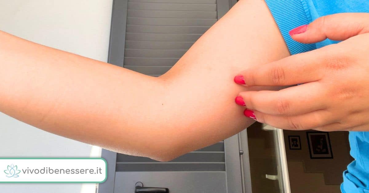 Come non farsi pungere dalle zanzare con rimedi da usare in casa
